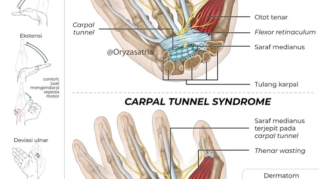 Carpal Tunnel Syndrome