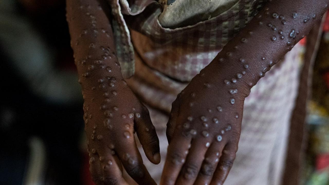 CEK FAKTA: Hoaks Virus Mpox Disebabkan karena Efek Samping Vaksin Covid-19