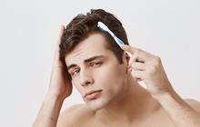 Cara Menumbuhkan Kembali Rambut yang Botak dan Pitak, Tidak Perlu Transplantasi hingga Turki
