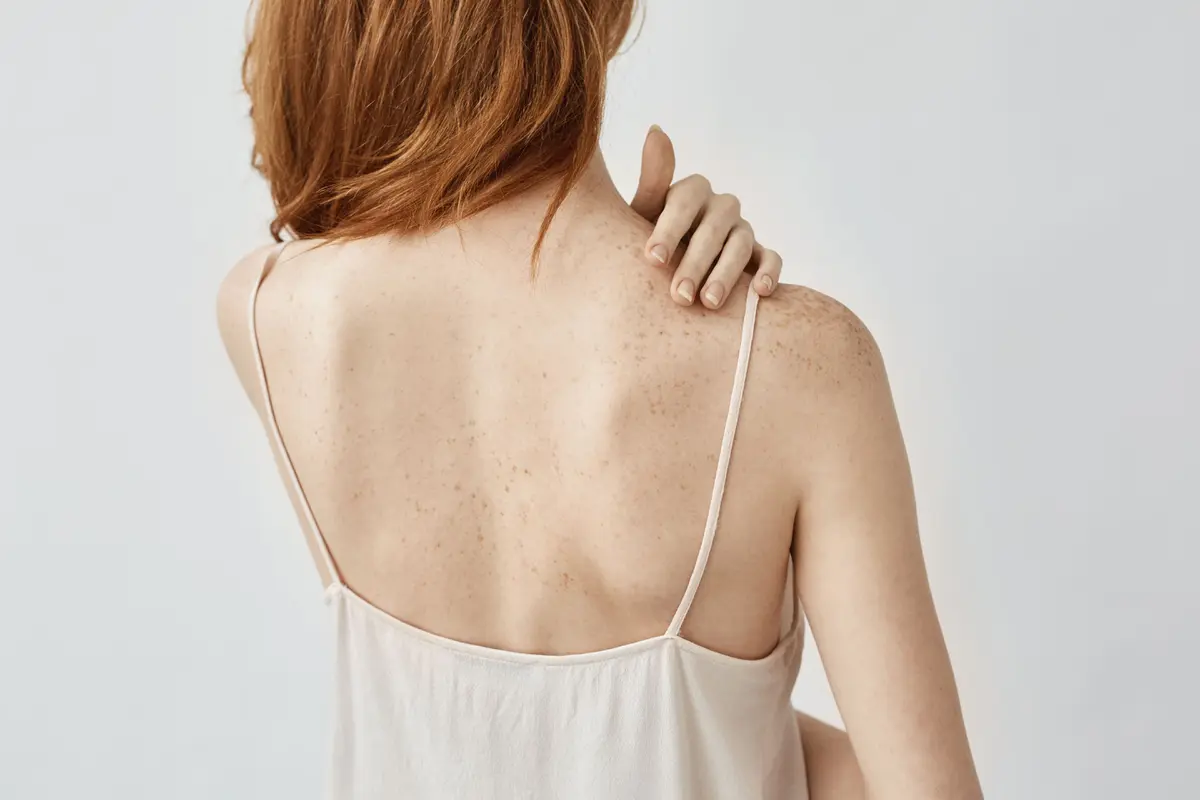 back acne