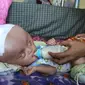 Bayi asal Bombana, Sultra, itu mengidap hidrosefalus dan kini dirawat kakek dan neneknya. (Liputan6.com/Eka Hakim)