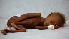 Seorang anak tergeletak di tempat tidur di unit malnutrisi perawatan intensif di sebuah rumah sakit di kota pelabuhan Laut Merah dari Hodaida, Yaman pada 11 September 2016. (REUTERS/Khaled Abdullah)