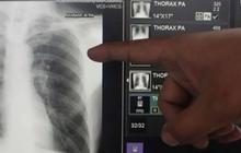 Banyak Pasien Tak Tahan Minum Obat Terus, Menkes Bakal Sederhanakan Pengobatan TBC dari 6 Bulan jadi 90 Hari