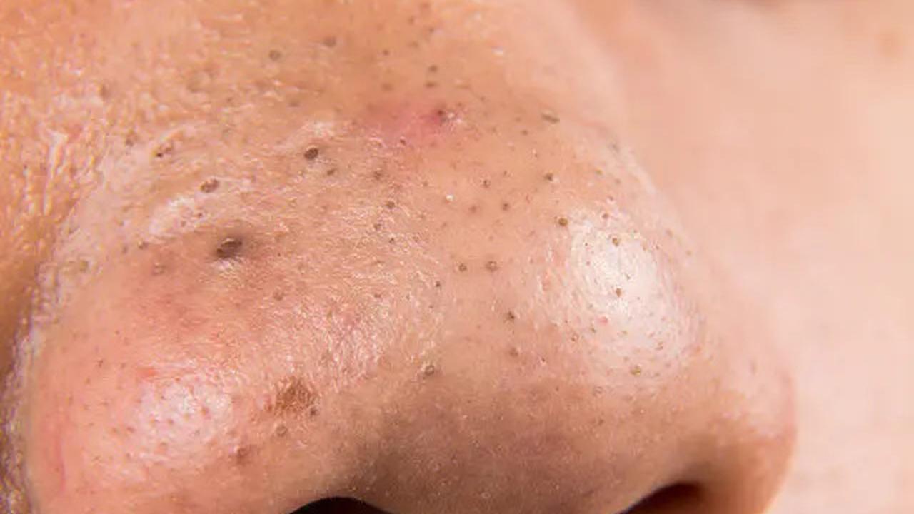 Cara Membuat Pore Pack Alami untuk Angkat Komedo Hanya dengan 3 Bahan