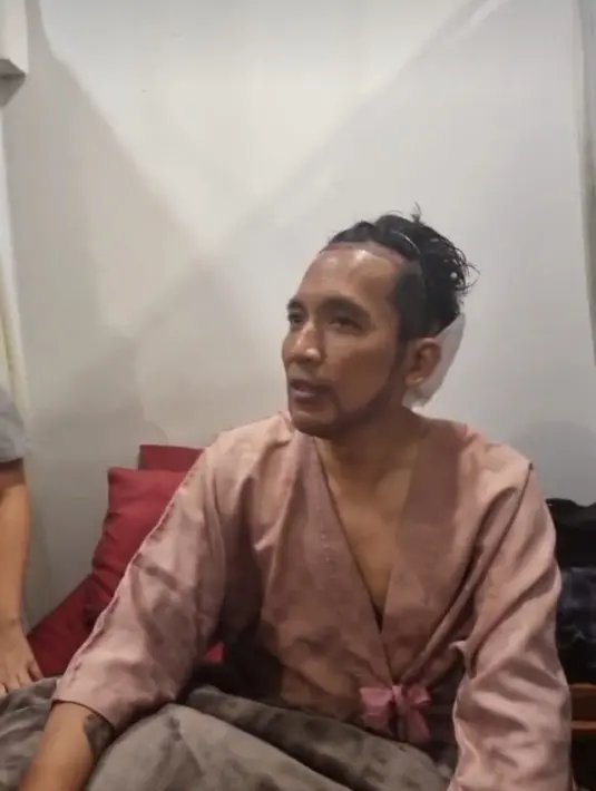<p>&ldquo;Ini kan gua memang jidatnya besar banget nih, jadi tanam rambut di sini tapi sekalian Bro (jenggot) tuh. Ada lebihan rambut gua banyak&rdquo; tutur Desta. (Foto: Instagram/ dr_tompi)</p>