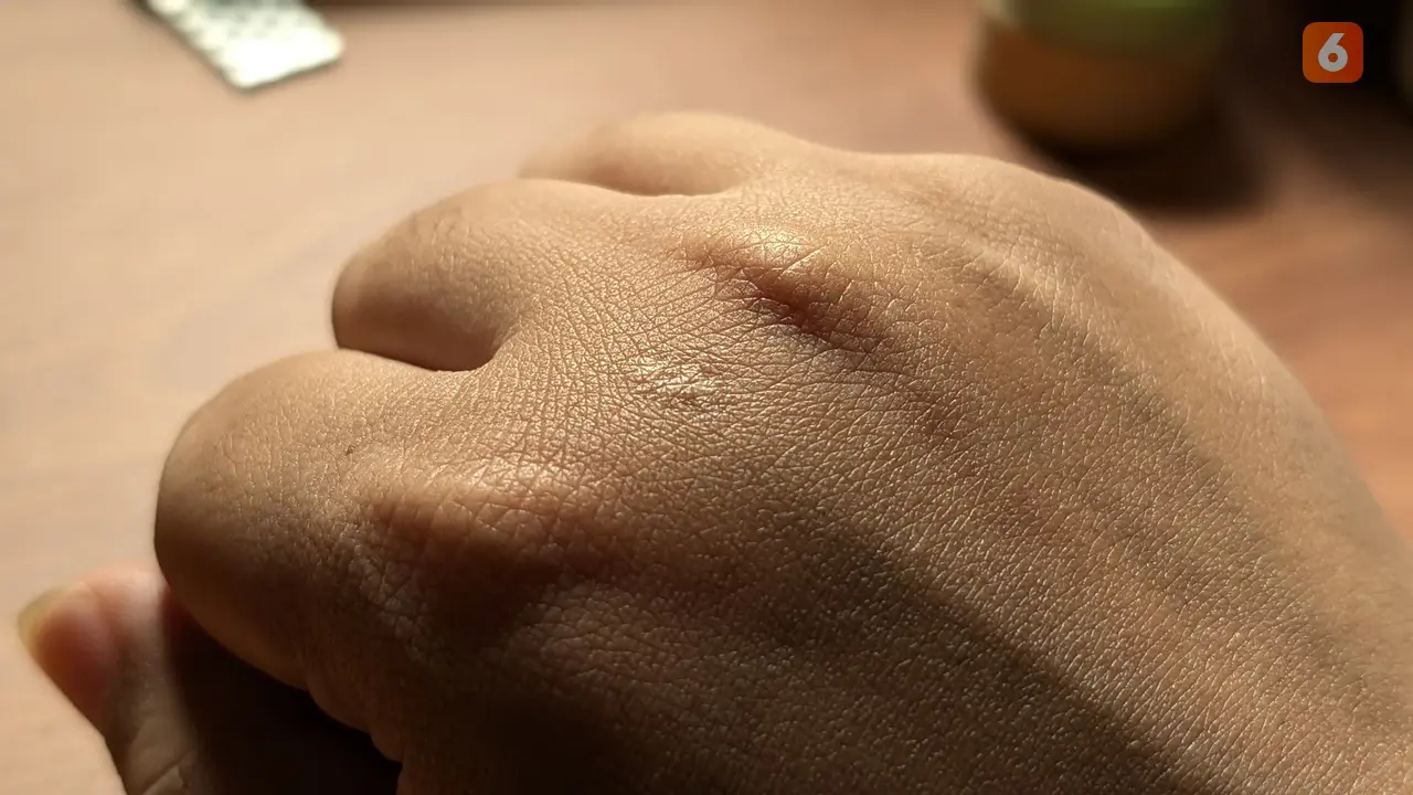 Keloid Tak Bisa Hilang Sendiri Meski Sudah Bertahun-tahun, Bagaimana Cara Mengatasinya?