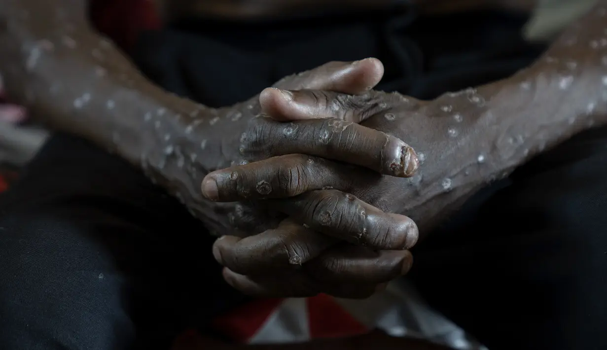 Seorang pria penderita mpox menunggu perawatan di Rumah Sakit Umum Kamituga di Kivu, Kongo Selatan, Rabu (4/9/2024). (AP Photo/Moses Sawasawa)