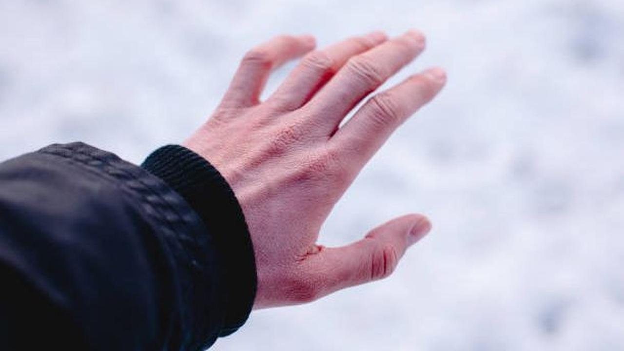 Tahap dan Gejala Frostbite