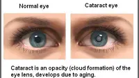 Fakoemulsifikasi yaitu teknik operasi mata katarak terbaru