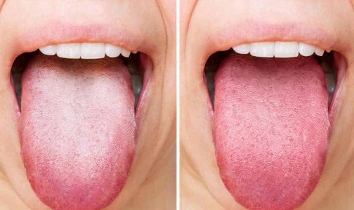 Warna Lidah Bisa Jadi Cermin Kesehatan Tubuh, Begini Cara Mengenalinya