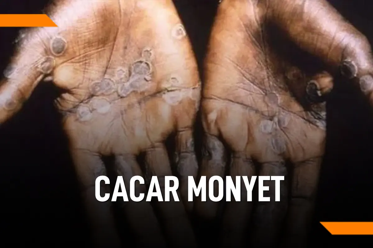 Beda Cacar Monyet dan Cacar Biasa