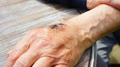 Tewaskan Satpam Serpong, Begini Cara Mengatasi Gigitan Ular Weling