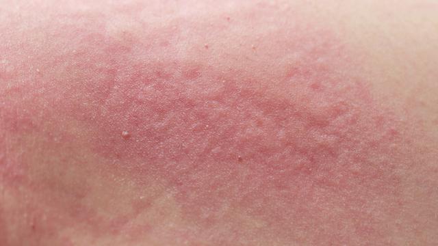 Ibu Baru Ketahui Masalah Kulit Setelah Melahirkan Health Liputan6 Com