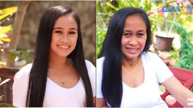 Idap Penyakit Langka, Wajah Gadis 16 Tahun Ini Terlihat Seperti Nenek