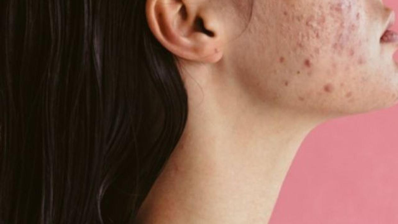 <b>Pilih Skincare yang Tepat untuk Kulit Acne Prone</b>