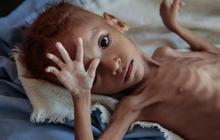 Hati-hati Rawan Malnutrisi Pada Anak, Cegah Sedari Dini