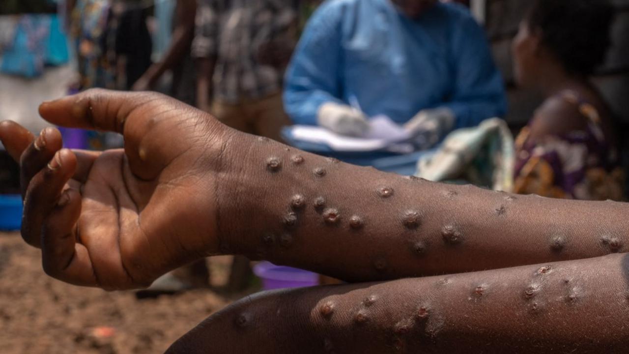 Wabah Mpox atau Cacar Monyet di Burundi