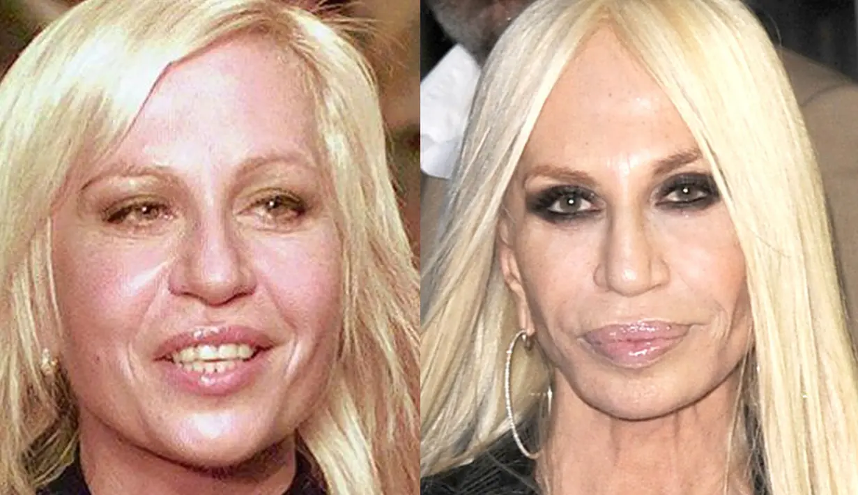 Donatella Versace adalah seorang perancang busana terkenal. Ia menjalani berbagai oplas untuk menjadikannya cantik seperti model-model yang mengenakan pakaian rancangannya. Hasilnya tak sesuai harapan.(Istimewa)