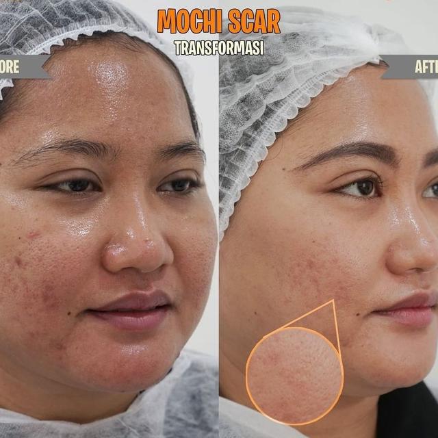 Tren Mochi Scar by Dermapro Jadi Solusi Menghaluskan dan Meregenerasi Kulit