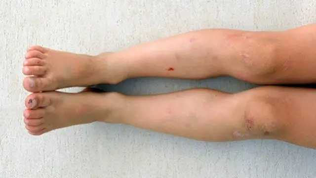 Kaki Diabetik Kerap Tak Disadari Sejak Dini, Kenali Gejala dan Tingkat Keparahan Lukanya