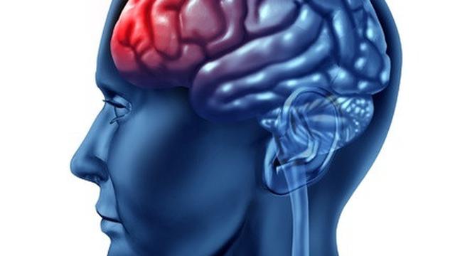 Waspadai Perdarahan di Dalam Otak!