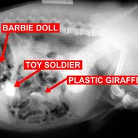 Gokil! Lima benda ini ditemukan terperangkap dalam tubuh manusia!!