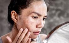 Apa itu Sunspots dan Bagaimana Gejalanya? Begini Cara Mengatasinya