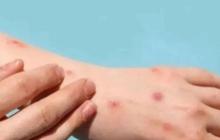 Kenali Gejala dan Cara Mengatasi Cacar Monyet Usai Santri di Meranti Meninggal Diduga Terinfeksi