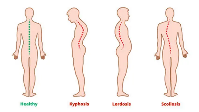 Kelainan Tulang Skoliosis, Kifosis, dan Lordosis