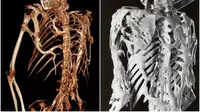 Sindrom Stoneman Bisa Ubah Otot Menjadi Tulang (Sumber: Reddit/stressed_kashmiri via Unilad)