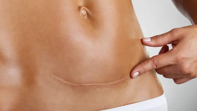 Pentingnya Jujur Miliki Bakat Keloid Saat Akan Melahirkan