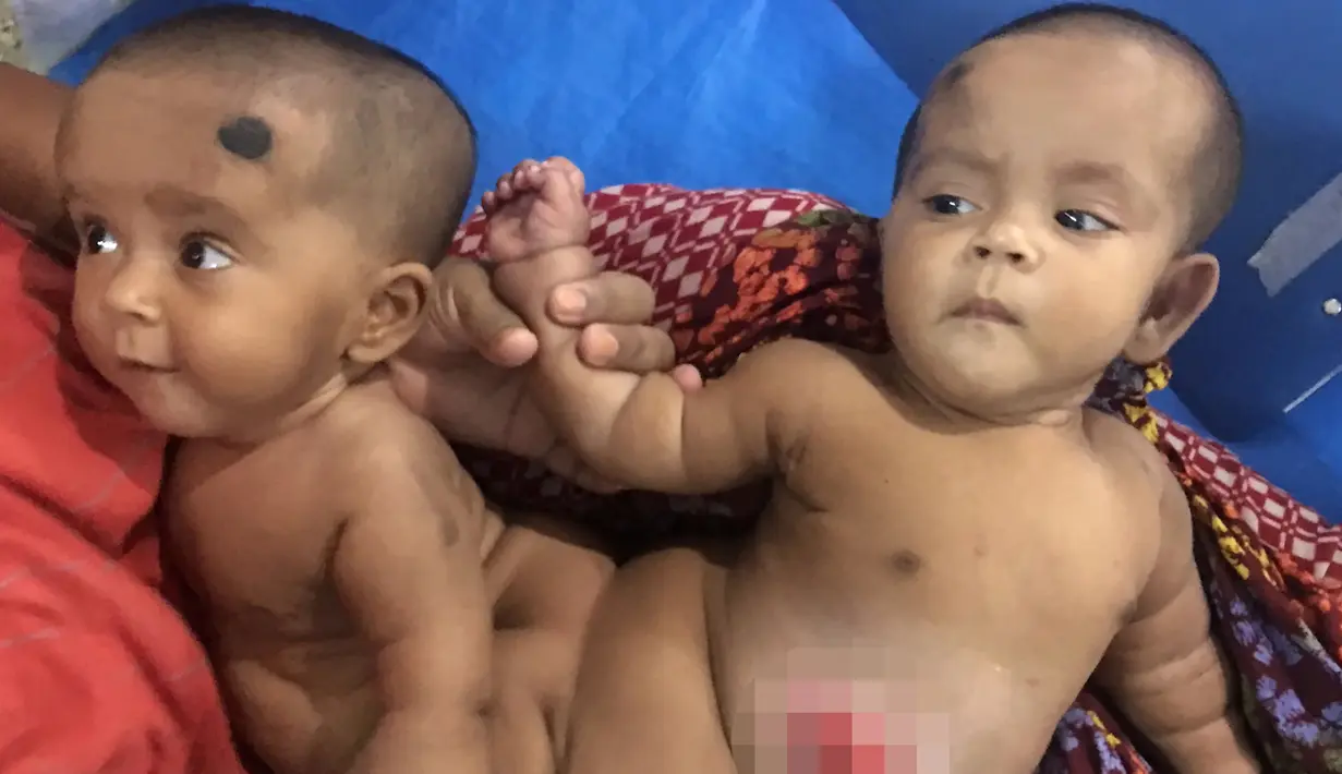 Tofa dan Tahura Bayi kembar siam saat sebelum operasi pemisahan di Rumah Sakit Medis Dhaka di Dhaka, Bangladesh (2/8). Dokter ahli bedah di Bangladesh telah berhasil memisahkan bayi kembar siam berusia 10 bulan tersebut. (AFP Photo/ Abdul Hanif Tablu)