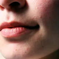Jerawat yang sering muncul dapat membuat perawatan kulit terasa tidak pernah benar-benar efektif (Sumber: Pexels.com)