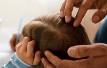 Cara Penularan Kutu Rambut Bikin Kepala Gatal Bukan Main, Ikuti Trik Mencegah dan Mengatasinya
