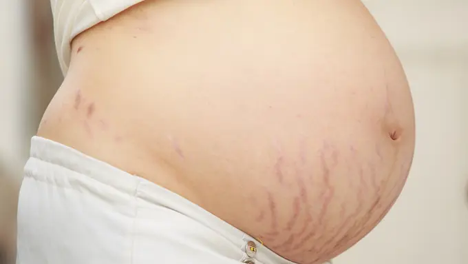 Stretch Mark - Vania