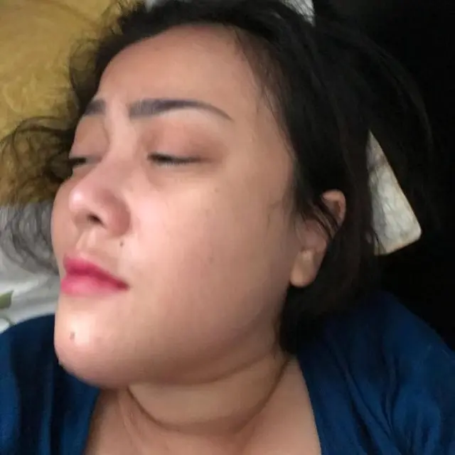 5 Potret Rency Milano Diduga Jadi Korban Malpraktik, Dagu Bengkak dan Bernanah