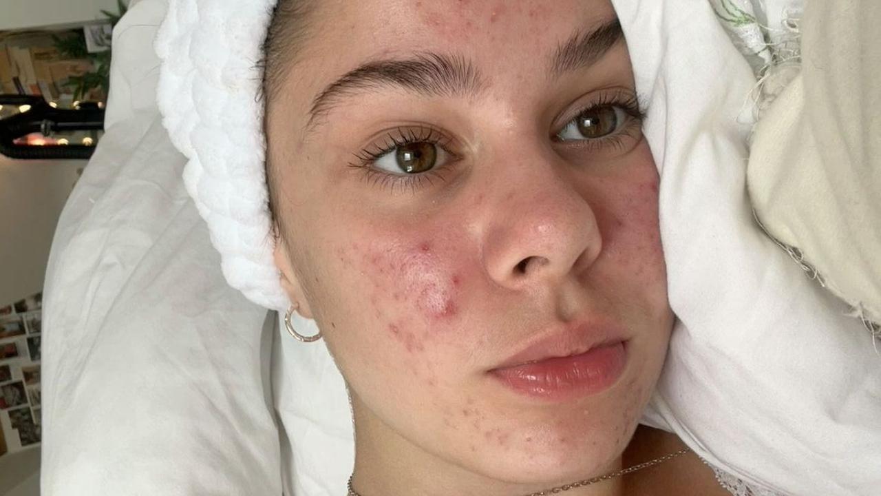 Jangan Abaikan Skin Barrier! Ini yang Terjadi pada Wajah saat Skip Perawatan Kulit