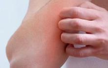 Gejala Psoriasis Vulgaris, Gangguan Autoimun Lesi Merah dan Bercak pada Kulit