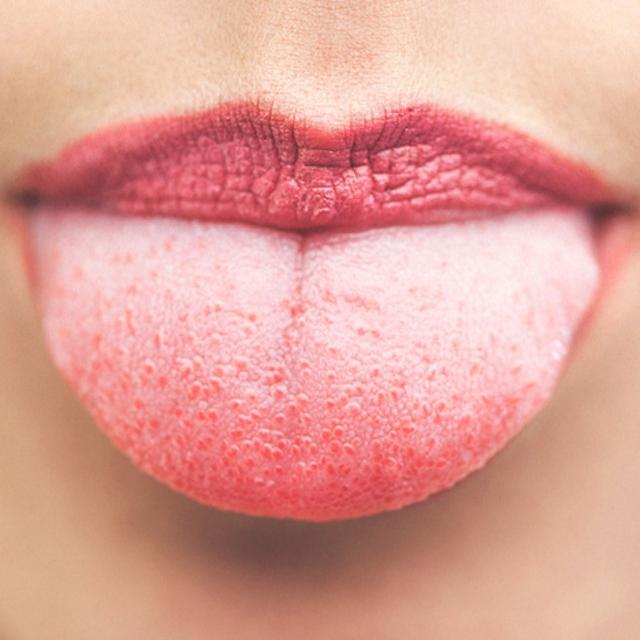 6 Penyebab Lidah Berwarna Putih Dan Cara Mengatasinya Hot Liputan6 Com