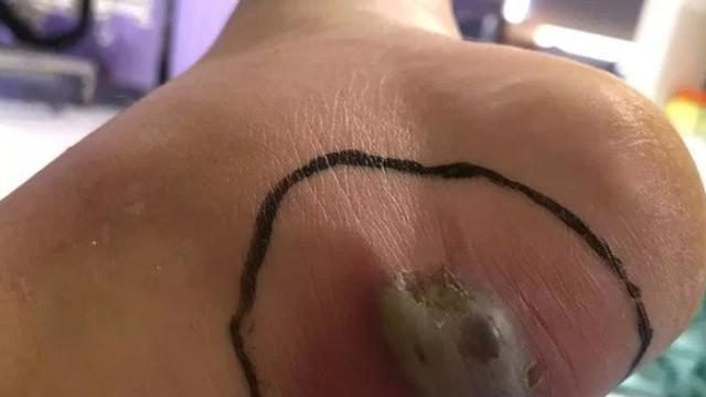 hampir meninggal karena heels