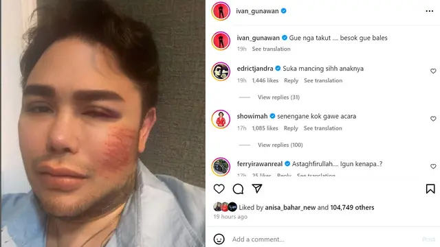 Ivan Gunawan Pakai Filter Lebam