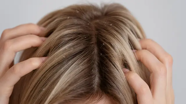 Dry Scalp