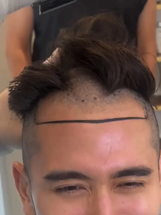 Verrell Bramasta tanam rambut (Instagram/bramastavrl)