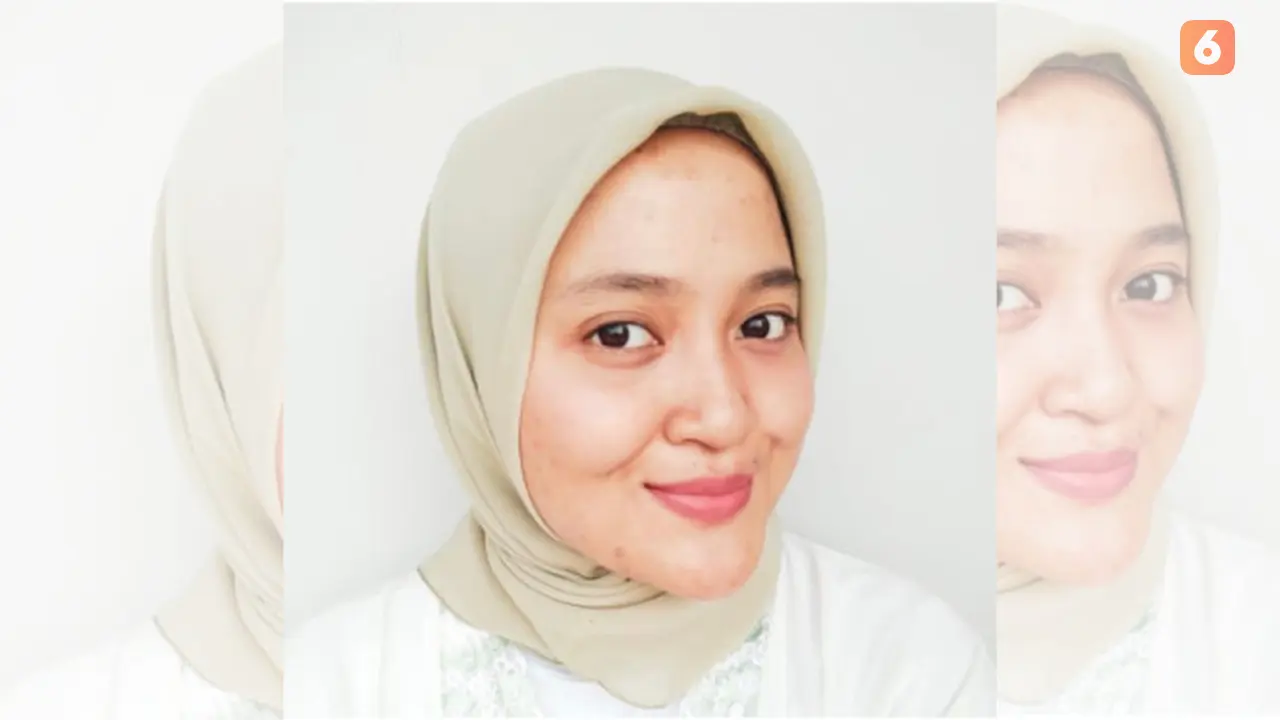 Nimas Mita Pasien Kanker Tulang atau Osteosarkoma.