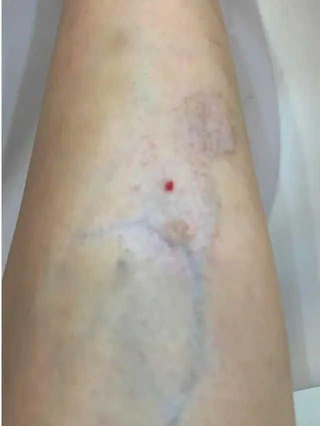 Suntik Filler Demi Hilangkan Gigitan Nyamuk, Selebgram Malah Alami Hal Mengerikan