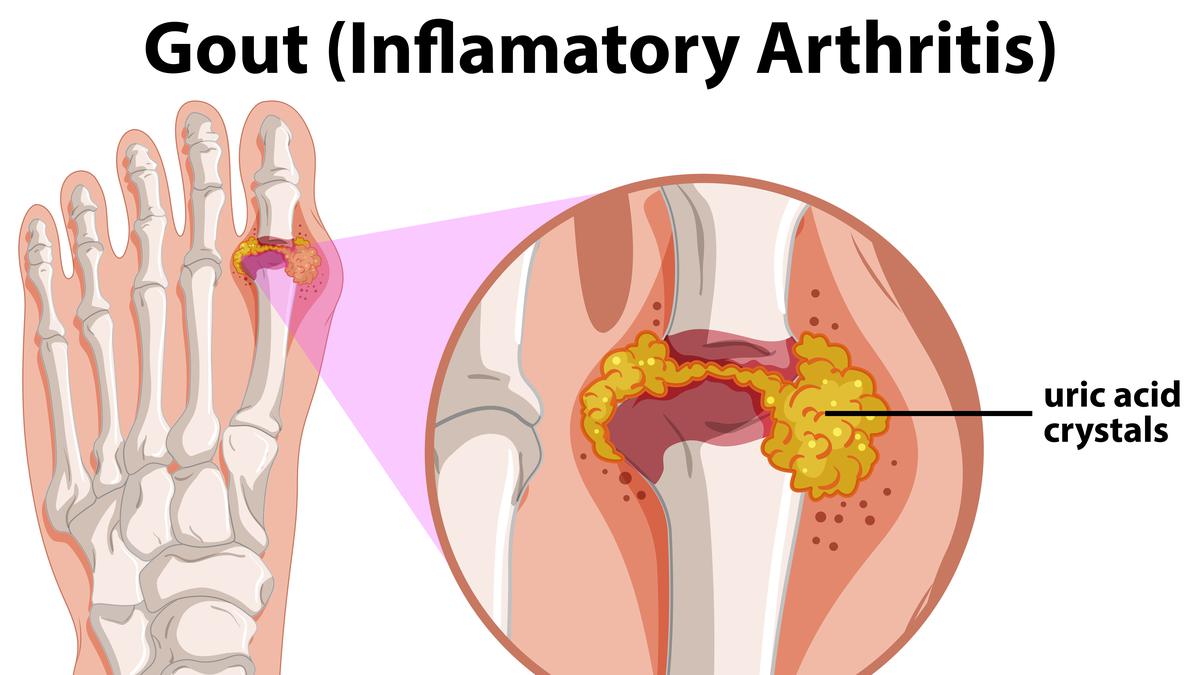 Mengenal Tofi pada Pengidap Asam Urat, Gejala dan Cara Menanganinya