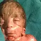 Betapa ironi, seorang bayi di Uttar Pradesh, India lahir dengan kondisi langka yang disebut sirenomelia atau Mermaid Syndrome. 