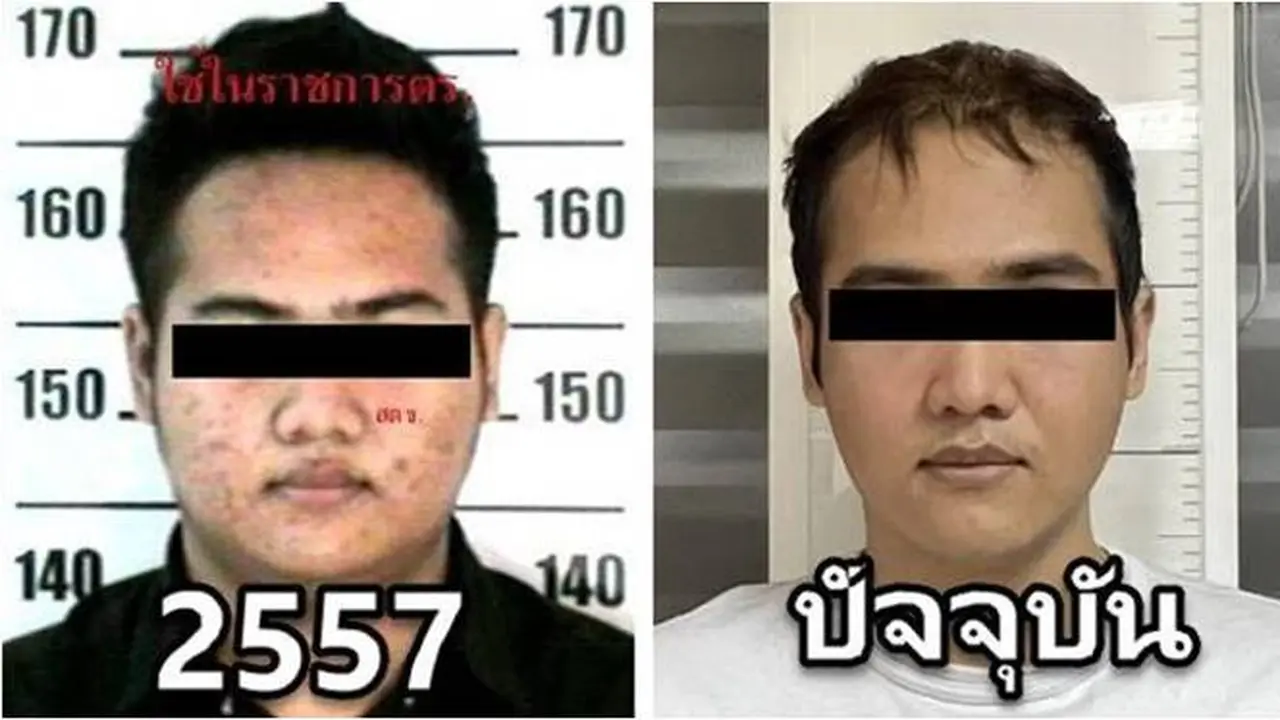 Hindari Polisi, Bandar Narkoba Jalani Operasi Plastik Sampai Mirip Orang Korea