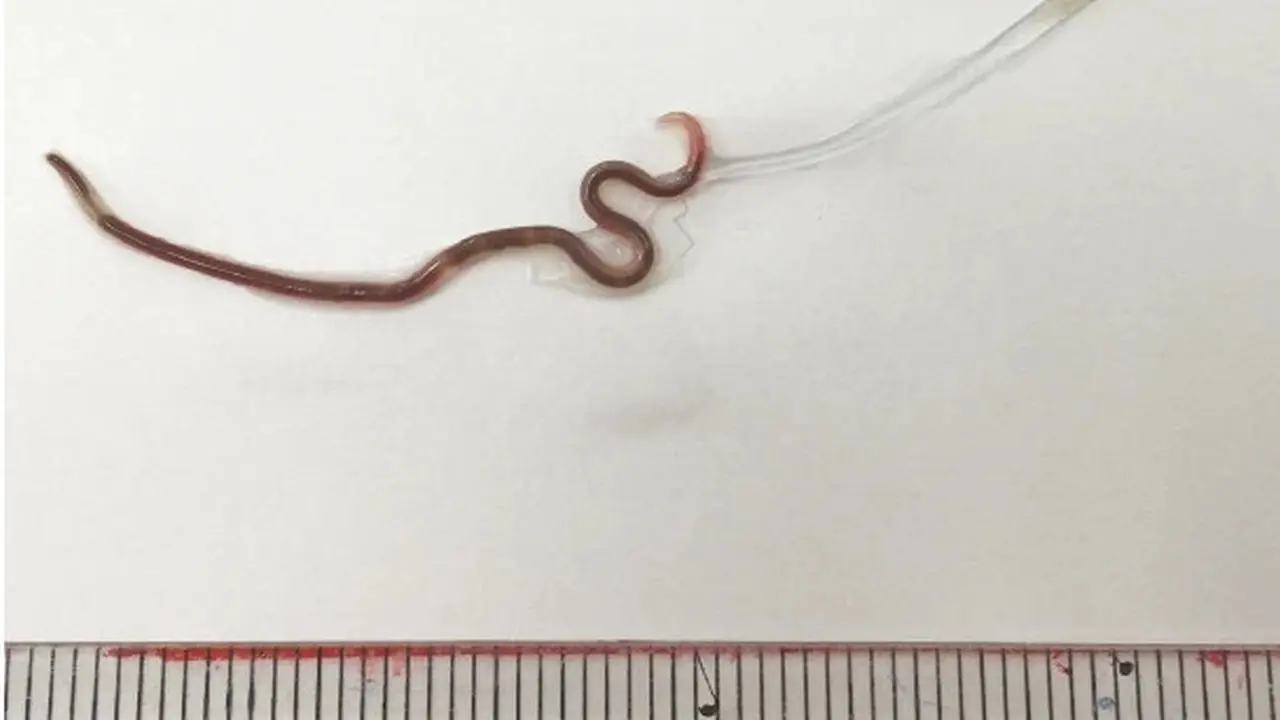 Mengeluh Amandel Sakit, Dokter Temukan Cacing 3 Cm di Tenggorokan Wanita yang Suka Makan Sashimi