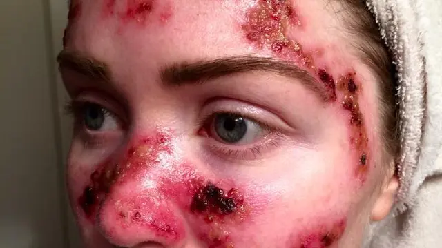 Wanita ini Berani Selfie Untuk Tingkatkan Kesadaran Kanker Kulit
